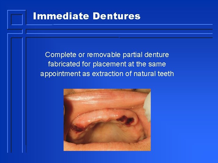 Immediate Dentures Complete or removable partial denture fabricated for placement at the same appointment