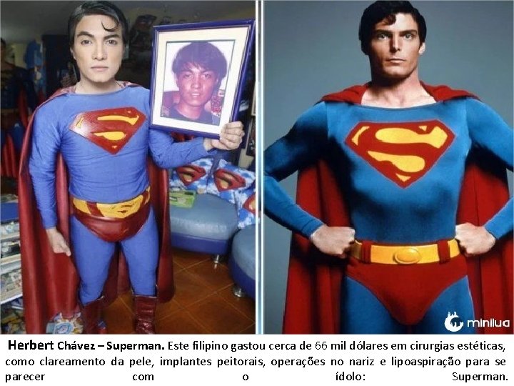 Herbert Chávez – Superman. Este filipino gastou cerca de 66 mil dólares em cirurgias