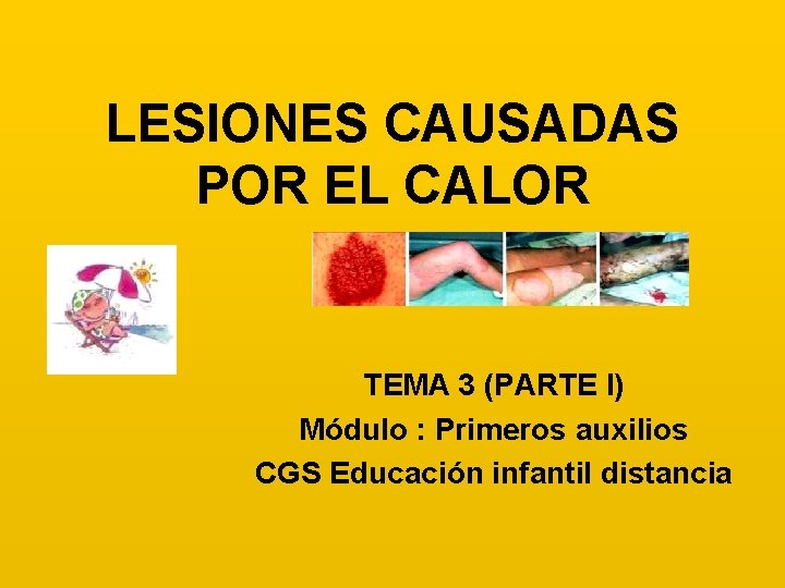 LESIONES CAUSADAS POR EL CALOR TEMA 3 (PARTE I) Módulo : Primeros auxilios CGS