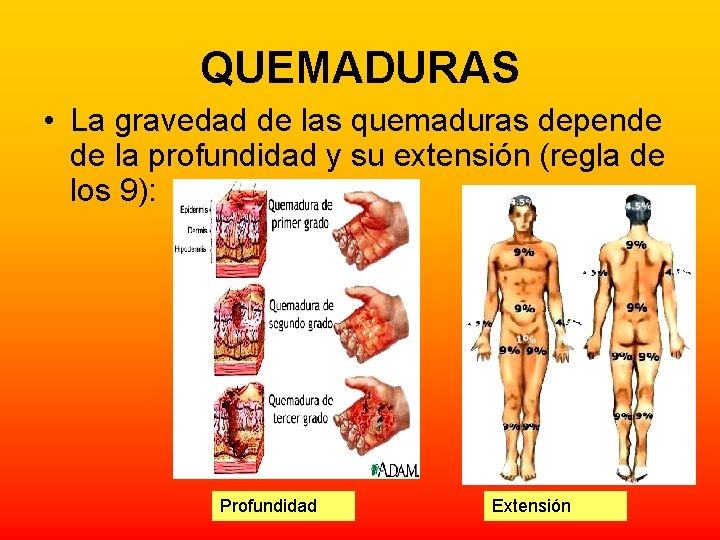 QUEMADURAS • La gravedad de las quemaduras depende de la profundidad y su extensión