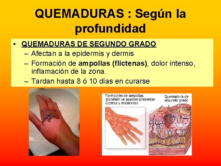 QUEMADURAS : Según la profundidad • QUEMADURAS DE SEGUNDO GRADO – Afectan a la