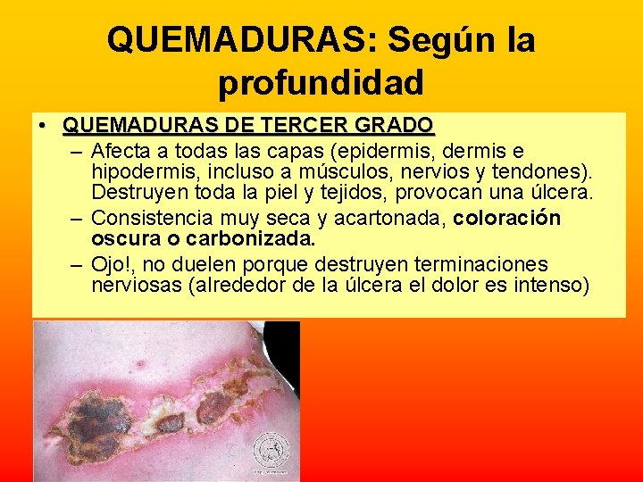 QUEMADURAS: Según la profundidad • QUEMADURAS DE TERCER GRADO – Afecta a todas las