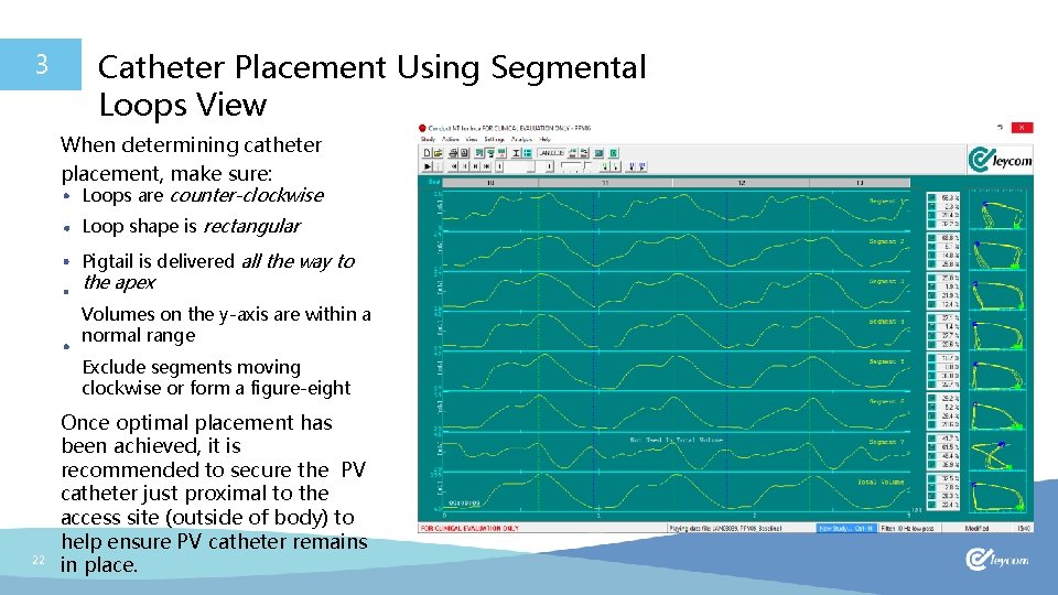 3 Catheter Placement Using Segmental Loops View When determining catheter placement, make sure: Loops
