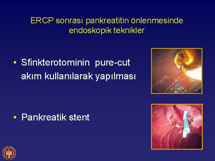 ERCP sonrası pankreatitin önlenmesinde endoskopik teknikler • Sfinkterotominin pure-cut akım kullanılarak yapılması • Pankreatik