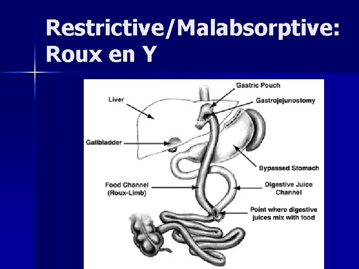 Restrictive/Malabsorptive: Roux en Y 