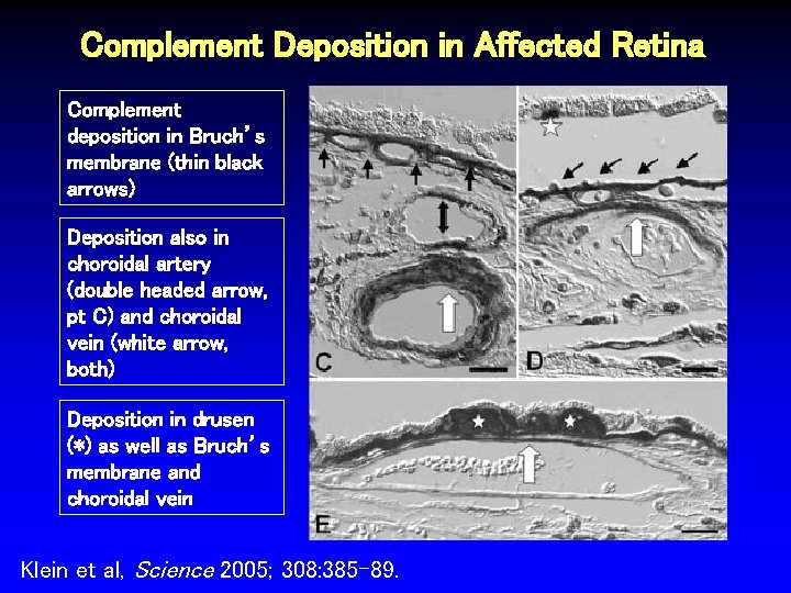 Complement Deposition in Affected Retina Complement deposition in Bruch’s membrane (thin black arrows) Deposition