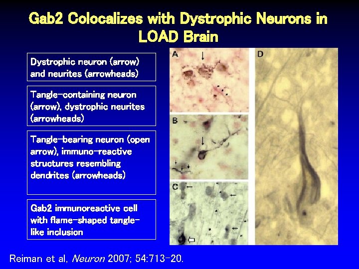 Gab 2 Colocalizes with Dystrophic Neurons in LOAD Brain Dystrophic neuron (arrow) and neurites