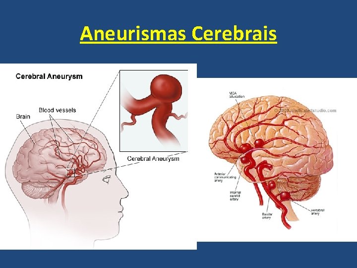 Aneurismas Cerebrais 