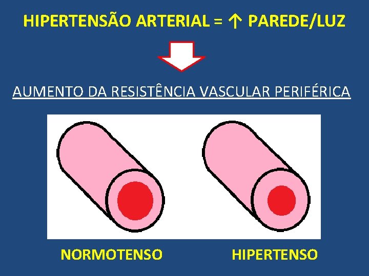 HIPERTENSÃO ARTERIAL = ↑ PAREDE/LUZ AUMENTO DA RESISTÊNCIA VASCULAR PERIFÉRICA NORMOTENSO HIPERTENSO 