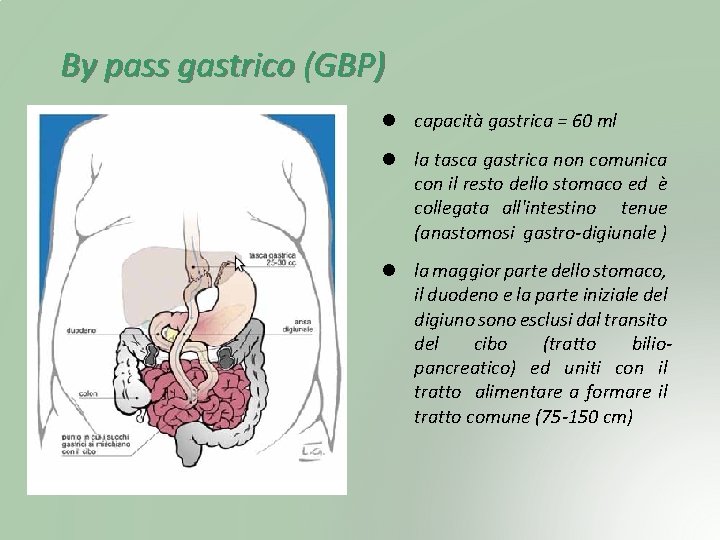 By pass gastrico (GBP) capacità gastrica = 60 ml la tasca gastrica non comunica