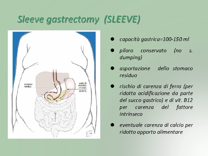 Sleeve gastrectomy (SLEEVE) capacità gastrica=100 -150 ml piloro conservato dumping) asportazione residuo (no s.