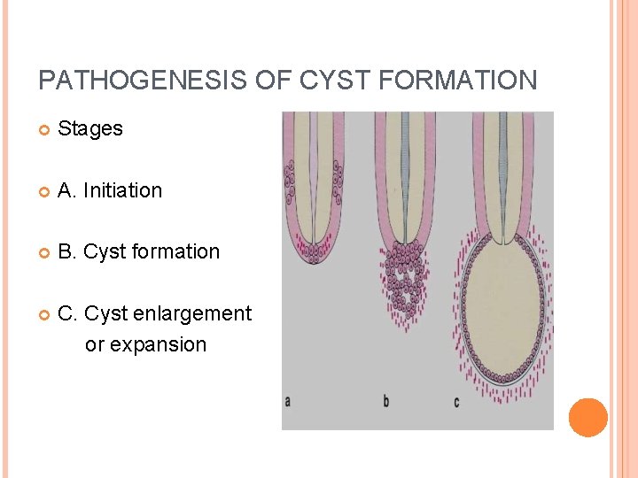PATHOGENESIS OF CYST FORMATION Stages A. Initiation B. Cyst formation C. Cyst enlargement or
