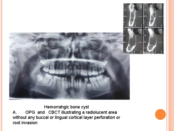  Hemorrahgic bone cyst A. OPG and CBCT illustrating a radiolucent area without any