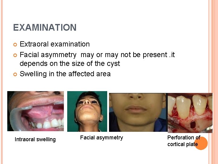 EXAMINATION Extraoral examination Facial asymmetry may or may not be present. it depends on