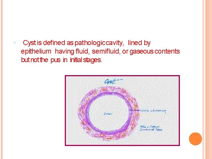  Cyst is defined as pathologic cavity, lined by epithelium having fluid, semifluid, or