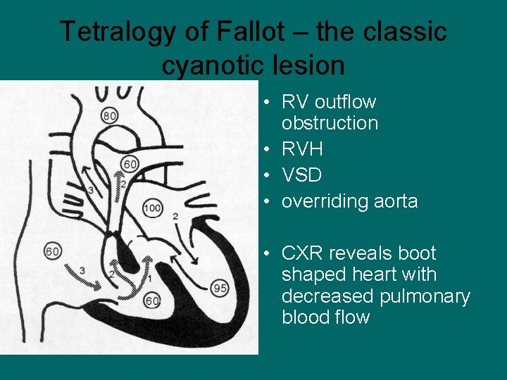 Tetralogy of Fallot – the classic cyanotic lesion • RV outflow obstruction • RVH
