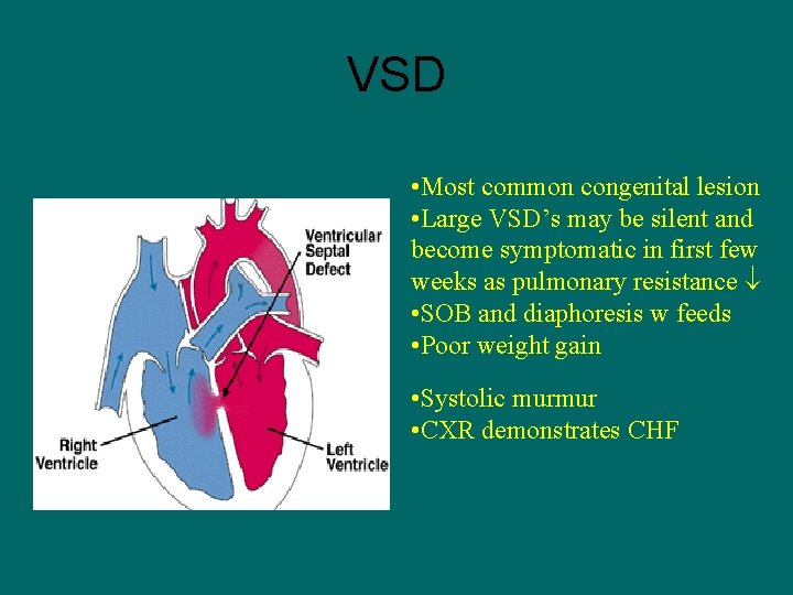 VSD • Most common congenital lesion • Large VSD’s may be silent and become