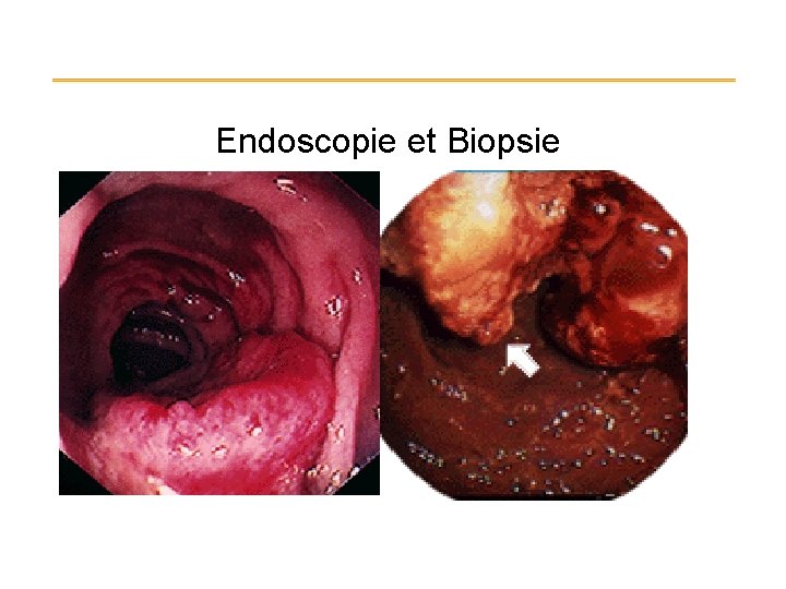 Endoscopie et Biopsie 