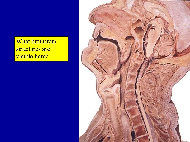What brainstem structures are visible here? 