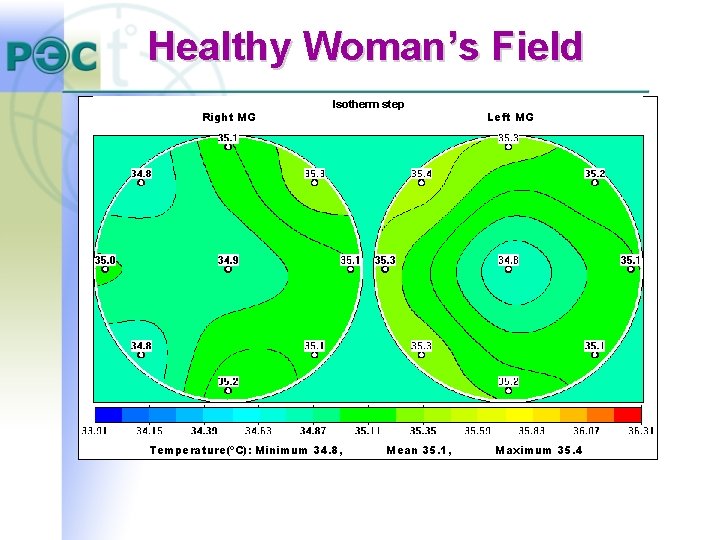 Healthy Woman’s Field Right MG Isotherm step Temperature(ºC): Minimum 34. 8, Mean 35. 1, Healthy Woman’s Field Right MG Isotherm step Temperature(ºC): Minimum 34. 8, Mean 35. 1,