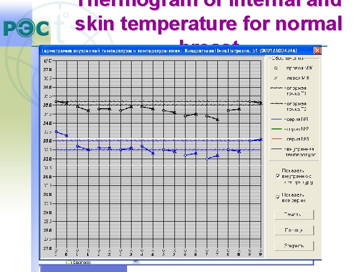 Thermogram of internal and skin temperature for normal breast Thermogram of internal and skin temperature for normal breast