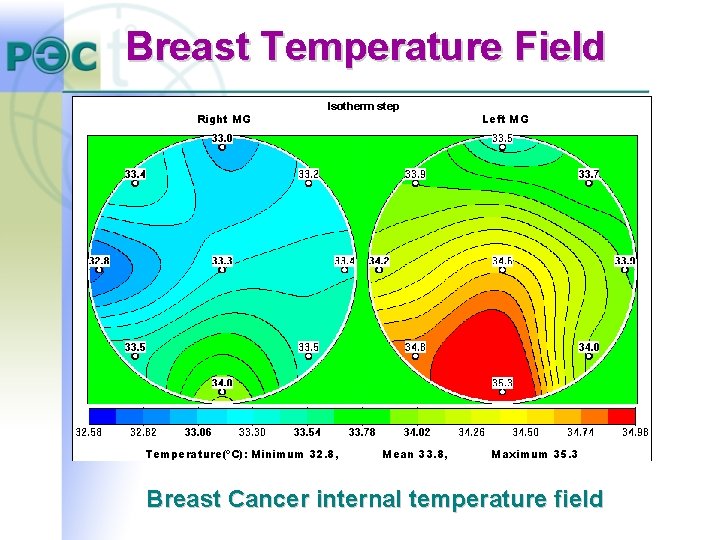Breast Temperature Field Right MG Isotherm step Temperature(ºC): Minimum 32. 8, Mean 33. 8, Breast Temperature Field Right MG Isotherm step Temperature(ºC): Minimum 32. 8, Mean 33. 8,