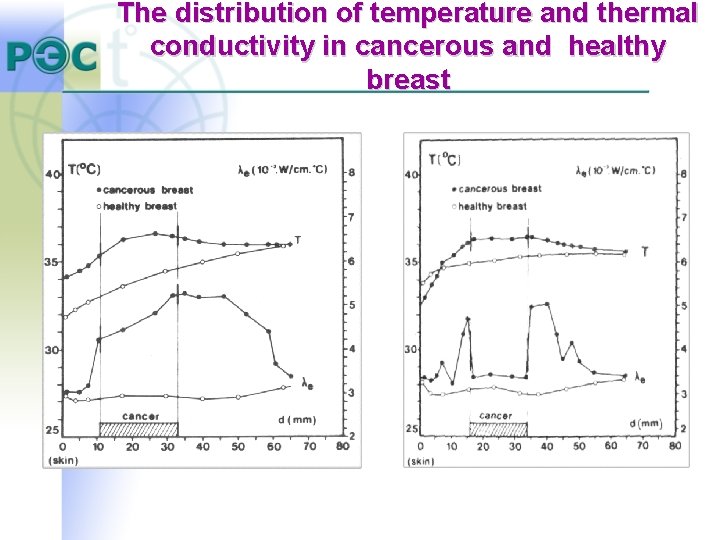 The distribution of temperature and thermal conductivity in cancerous and healthy breast The distribution of temperature and thermal conductivity in cancerous and healthy breast