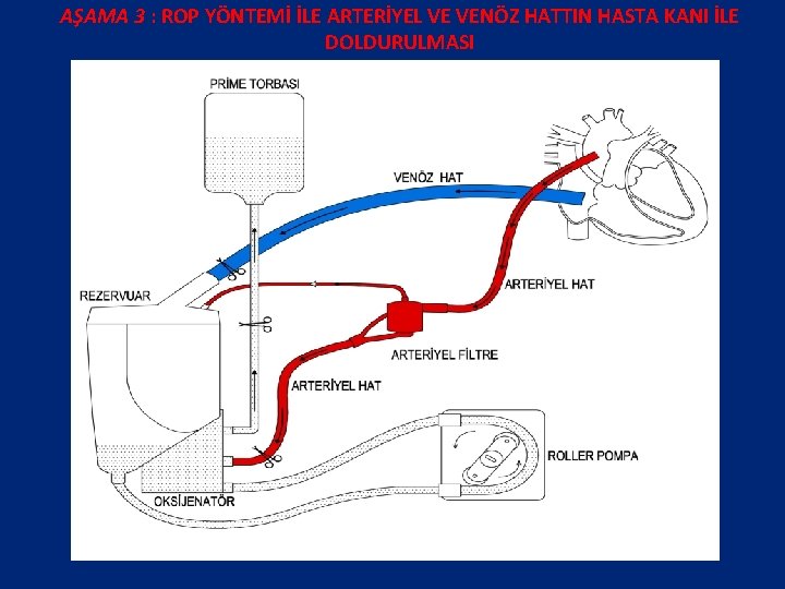 AŞAMA 3 : ROP YÖNTEMİ İLE ARTERİYEL VE VENÖZ HATTIN HASTA KANI İLE DOLDURULMASI