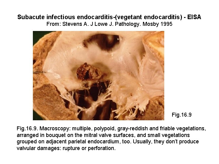 Subacute infectious endocarditis-(vegetant endocarditis) - EISA From: Stevens A. J Lowe J. Pathology. Mosby