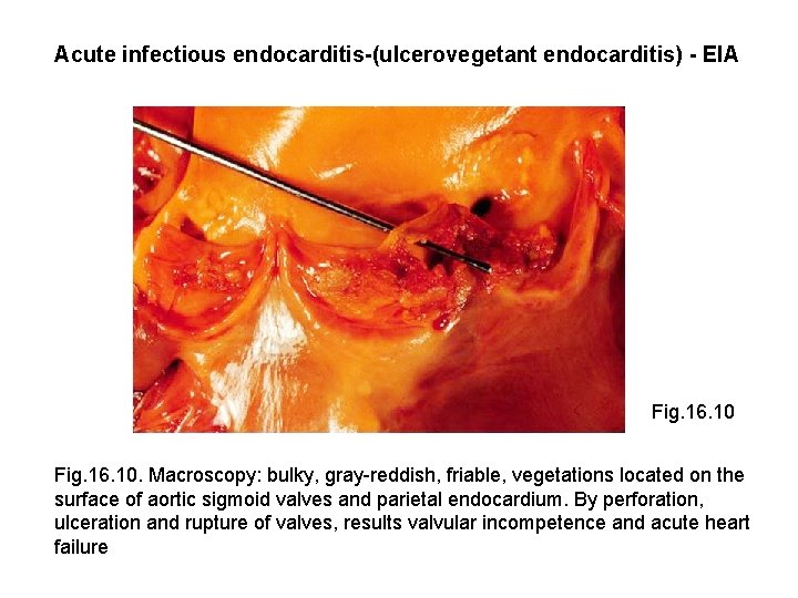 Acute infectious endocarditis-(ulcerovegetant endocarditis) - EIA Fig. 16. 10. Macroscopy: bulky, gray-reddish, friable, vegetations