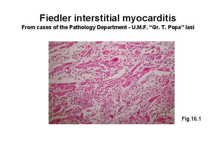 Fiedler interstitial myocarditis From cases of the Pathology Department - U. M. F. “Gr.