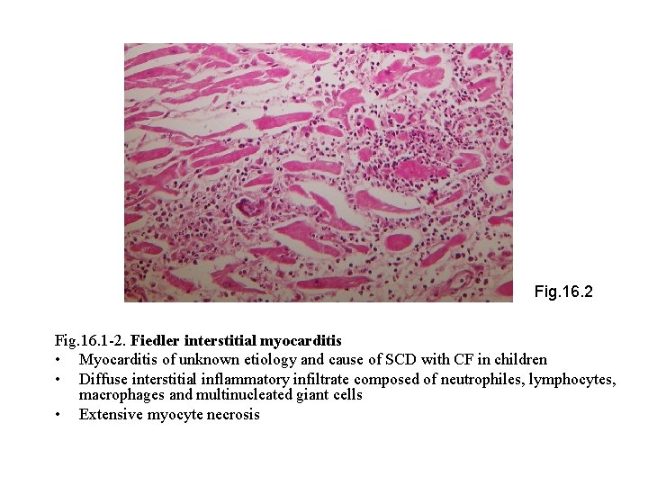 Fig. 16. 2 Fig. 16. 1 -2. Fiedler interstitial myocarditis • Myocarditis of unknown