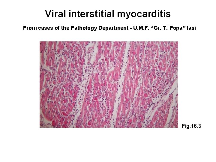 Viral interstitial myocarditis From cases of the Pathology Department - U. M. F. “Gr.
