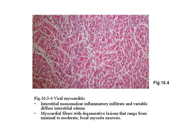 Fig. 16. 4 Fig. 16. 3 -4 Viral myocarditis • Interstitial mononuclear inflammatory infiltrate