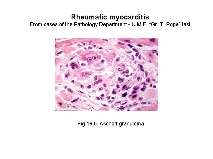 Rheumatic myocarditis From cases of the Pathology Department - U. M. F. “Gr. T.