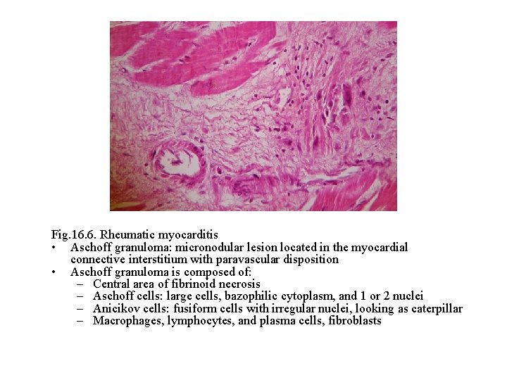 Fig. 16. 6. Rheumatic myocarditis • Aschoff granuloma: micronodular lesion located in the myocardial