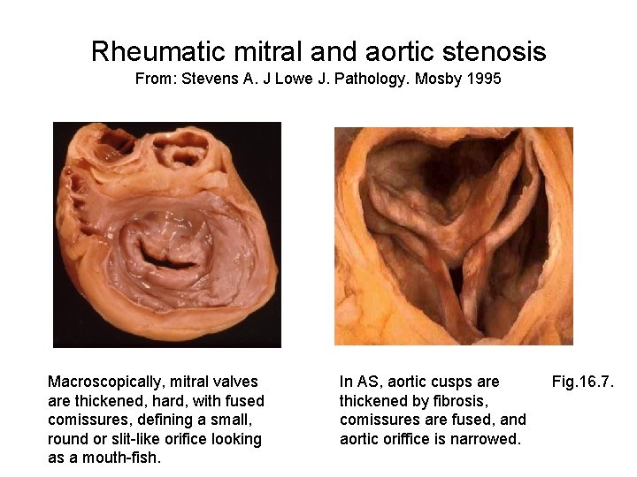 Rheumatic mitral and aortic stenosis From: Stevens A. J Lowe J. Pathology. Mosby 1995