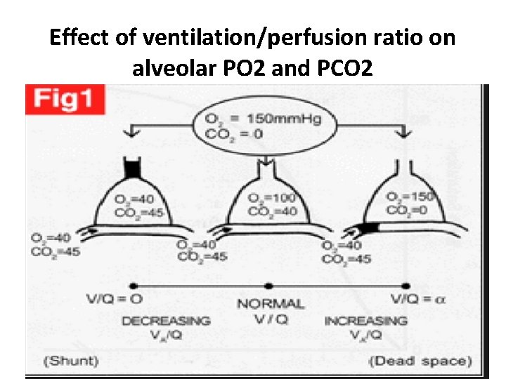 Effect of ventilation/perfusion ratio on alveolar PO 2 and PCO 2 