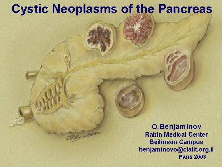 Cystic Neoplasms of the Pancreas O. Benjaminov Rabin Medical Center Beilinson Campus benjaminovo@clalit. org.