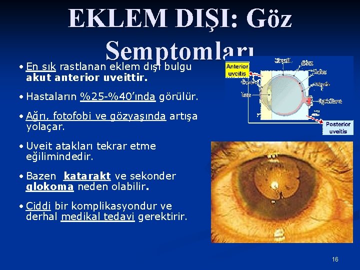 EKLEM DIŞI: Göz Semptomları • En sık rastlanan eklem dışı bulgu akut anterior uveittir.