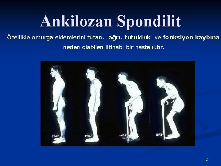 Ankilozan Spondilit Özellikle omurga eklemlerini tutan, ağrı, tutukluk ve fonksiyon kaybına neden olabilen iltihabi