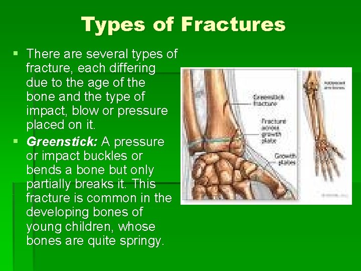 Types of Fractures § There are several types of fracture, each differing due to