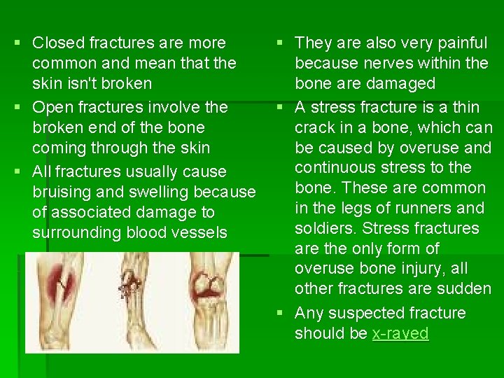 § Closed fractures are more common and mean that the skin isn't broken §
