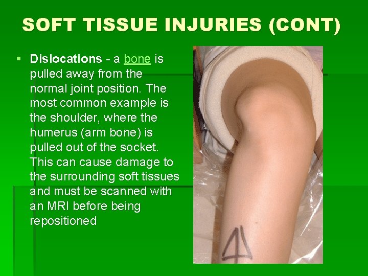 SOFT TISSUE INJURIES (CONT) § Dislocations - a bone is pulled away from the