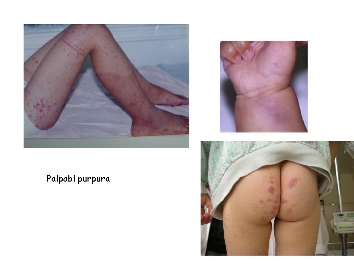 Palpabl purpura Palpabl purpura