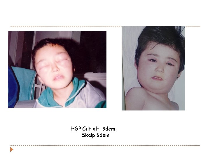 HSP Cilt altı ödem Skalp ödem HSP Cilt altı ödem Skalp ödem