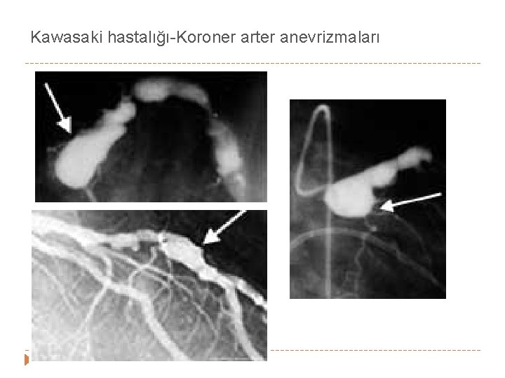 Kawasaki hastalığı-Koroner arter anevrizmaları Kawasaki hastalığı-Koroner arter anevrizmaları