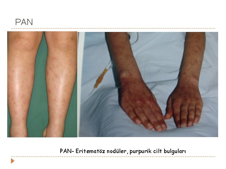 PAN PAN- Eritematöz nodüler, purpurik cilt bulguları PAN PAN- Eritematöz nodüler, purpurik cilt bulguları
