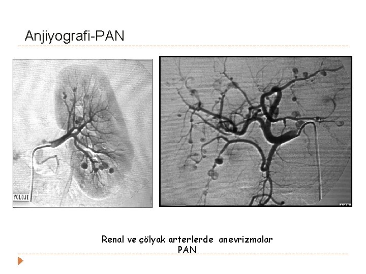 Anjiyografi-PAN Renal ve çölyak arterlerde anevrizmalar PAN Anjiyografi-PAN Renal ve çölyak arterlerde anevrizmalar PAN