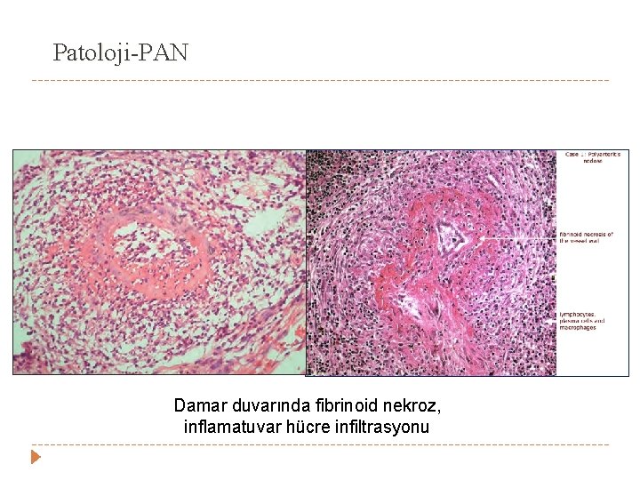 Patoloji-PAN Damar duvarında fibrinoid nekroz, inflamatuvar hücre infiltrasyonu Patoloji-PAN Damar duvarında fibrinoid nekroz, inflamatuvar hücre infiltrasyonu